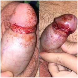 cutthecock:  5 hours after the operation.  Circumcision moments of pain for a life time of benefit