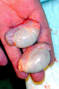 emptyscrotum:Human testicles 