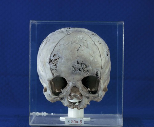 Syphilis of the cranium 