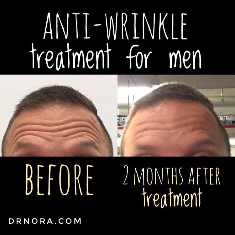 Anti-wrinkle treatment for men! With results expected to last up to 3-5 months, many more men are signing up of anti-wrinkle treatment to get a fresher, youthful look.
Is it time you got onto the ‘Brotox’ movement? 💉
Book in today for a consultation...