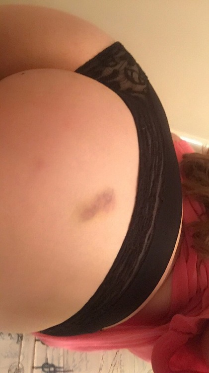 mildsexappeal: Bruises make for better conversation.