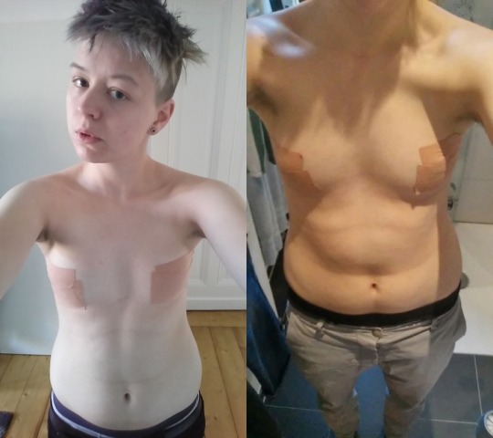 Trans Tape! ;> My chest looks so good, especially in this photo! : r/ftm