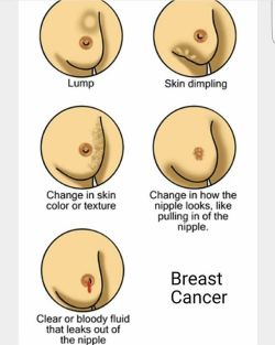 yourstudymate:  Breast cancer is the most