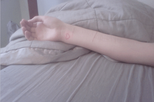 switcch:hurtfawn:scars will heal soon.oh bby