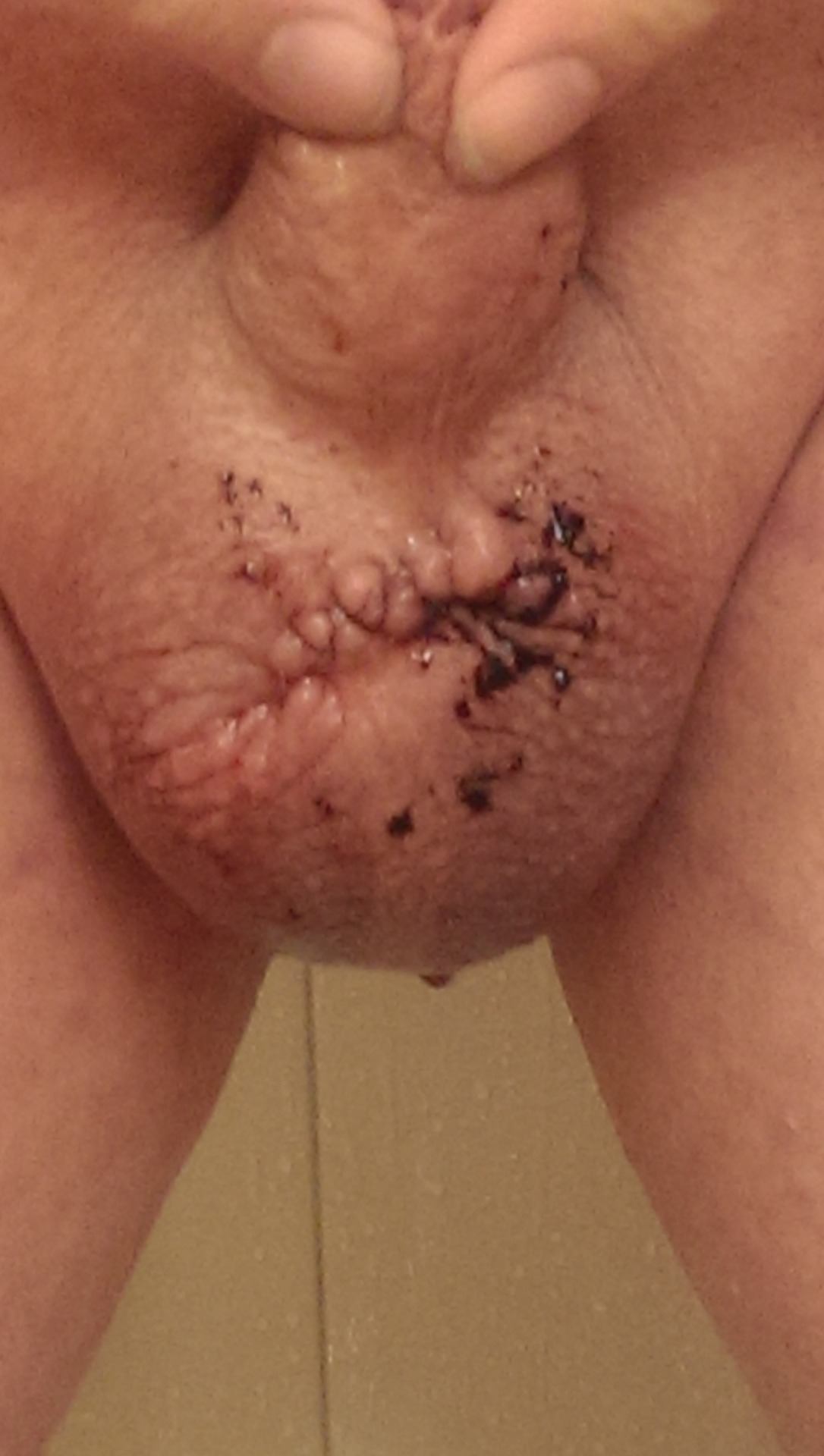 miah-akston:  Before&gt; during&gt;removed&gt;diapersftw&gt;incision&gt;swollen&gt;superlongdraintube
