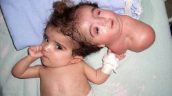 pickledplacenta:  “Manar Maged—born in Cairo in 2004—also suffered from parasitic twin. Manar and her twin sister were fused together at the head. Her twin had no limbs and could only smile, blink and cry. At ten months of age, Manar was taken to