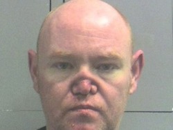 Collapsed Nose Resulting From Cocaine Addiction