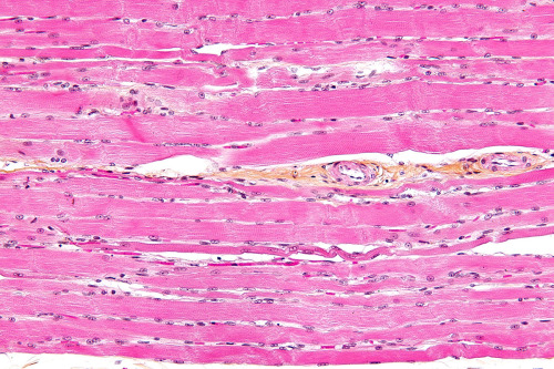 A Clue to Why Cancer Often Involves Muscle LossMany cancer patients gradually lose significant skele