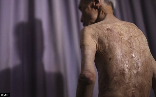 sixpenceee:  Atomic Bomb Survivor: Sumitery Taniguchi The frail 86-year-old body of Sumitery Taniguchi is a web of scars, that have criss-crossed his skin for 70 years. The elderly man was one of the many tens of thousands of victims of the atomic blast