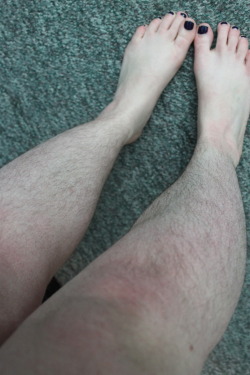 hairylegsclub:I stopped shaving in October 2014 and I’m really hoping I can get the courage this summer to go out with covering my legs. I shouldn’t die from the heat just because some people don’t like the way my body looks.  They are special.