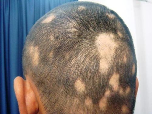 Alopecia Symptoms, Hair Baldness and Its Treatment in HomoeopathyAlopecia aka Alopecia areata is a c