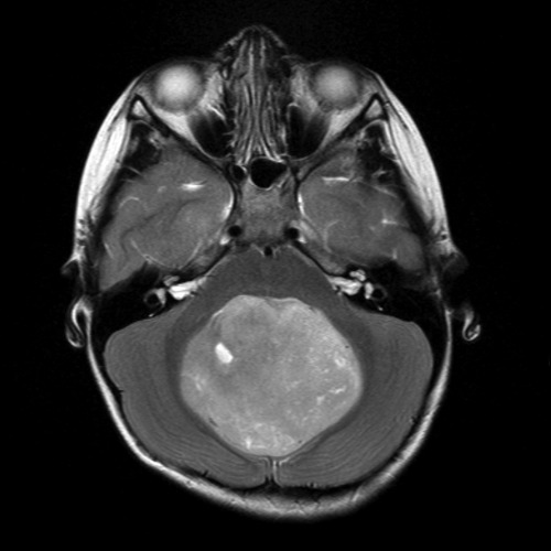 medicalschool:  homo-medicus: Medulloblastoma Medulloblastoma is a highly malignant primary brain tumor that originates in the cerebellum or posterior fossa. Tumors that originate in the cerebellum are referred to as infratentorial because they occur