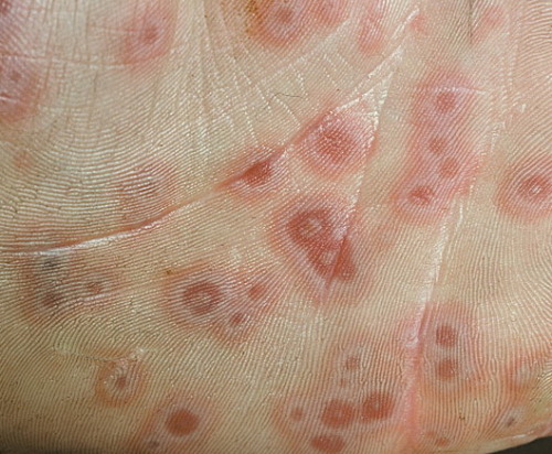 Erythema Multiforme This is a skin condition characterised by target lesions, like multiple smaller 