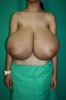 Real Life Big Breasts #8Macromastia Medical Photo - Patient with