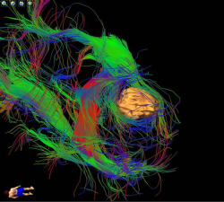 ucsdhealthsciences:  UC San Diego neurosurgeons color code the brain with tractography - the circular object is a tumor. Brain Surgeons Go with the FlowWater-Based Imaging Technique Maps Brain Neurons Prior to Surgery Neurosurgeons at UC San Diego Health