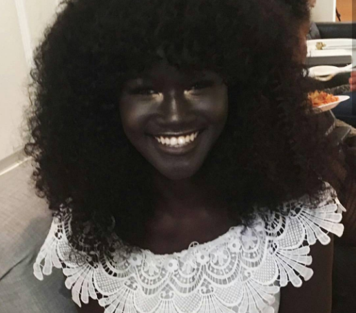 Teen Bullied For Complexion Is Now A Model And Instagram Sensation