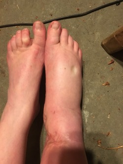 iamatinyowl:  iamatinyowl:  This is what I’m dealing with right now. My entire foot is so itchy because of how swollen it is the skin is pulled so tight :(     IT IS SO MUCH WORSE TODAY   Rub your vagina on it or vagina of a friend, a transgender woman’s