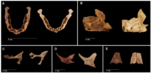 theolduvaigorge: Alterations of skull bones found in anencephalic skeletons from an identified 