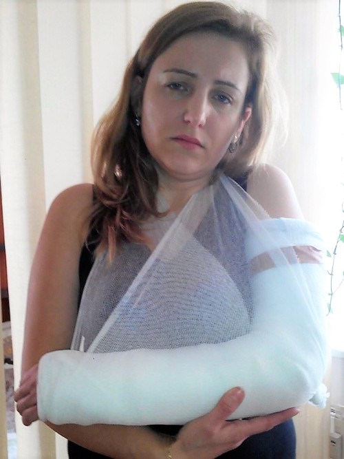 A nice fresh cast on a broken arm