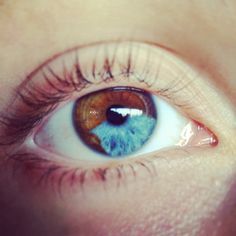 sixpenceee:  In sectoral heterochromia one part of the eye is different from it’s remainder. Heterochromia, in general is the result of excessive pigment. It can be inherited or caused by disease & injury.  