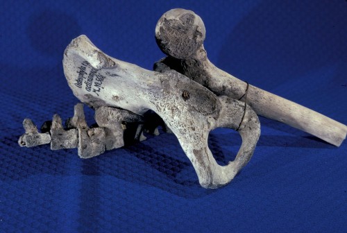 Actinomycosis of the femur, os coxa, sacrum, verts. 