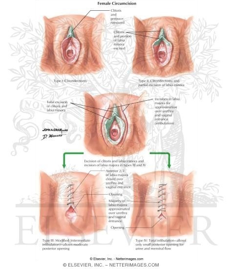 Female genital mutilation before and after