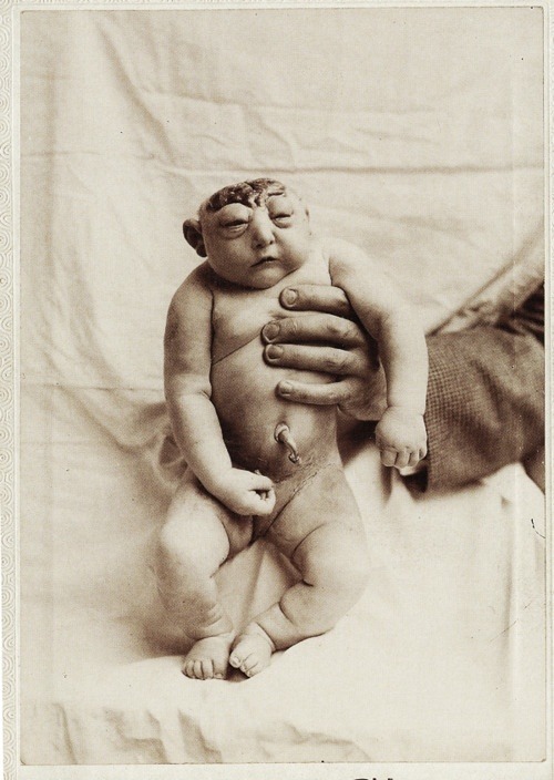 Anencephaly c. 1890’s. (Anencephaly is a neural tube defect that occurs when the cephalic end of the neural tube fails to close, resulting in the absence of a major portion of the brain, skull, and scalp.)