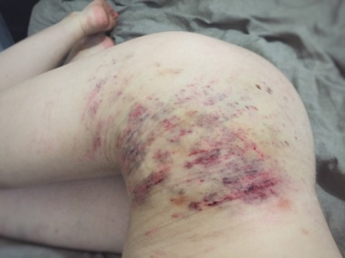 handprints-and-hickies: defiantly-yourss: Reoccurring theme: me bruised and crying. ugh i want someo