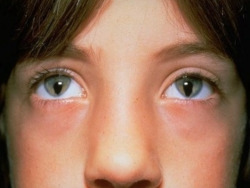 sixpenceee:  Congenital iris coloboma is a hole or defect of the iris. It can affect one or both eyes and causes varying levels of blindness. 