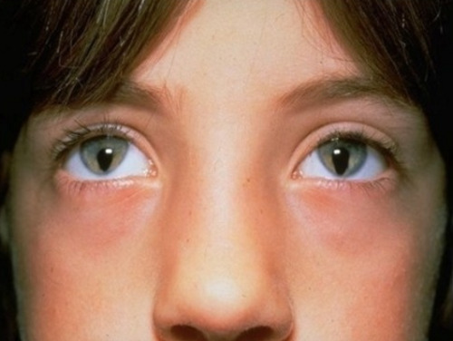 sixpenceee:  Congenital iris coloboma is a hole or defect of the iris. It can affect one or both eyes and causes varying levels of blindness. 