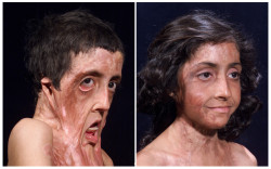 Rectalglitter:  Stunningpicture:  Burn Victim Gets Facial Reconstruction, Doctors