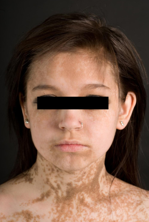 17-year old woman with an extensive, systemic epidermal nevus following the lines of Blaschko. [sour