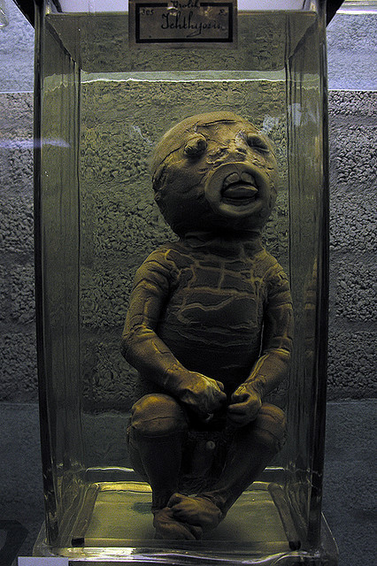 sixpenceee: Harlequin-type ichthyosis is a skin disease Infants with this condition are born with ve