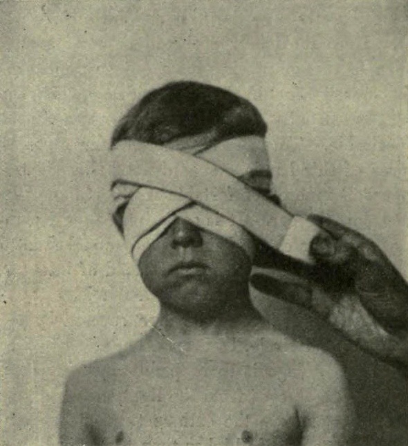  Figure of eight bandage of both eyes, from Edward M. Foote’s A text-book of minor