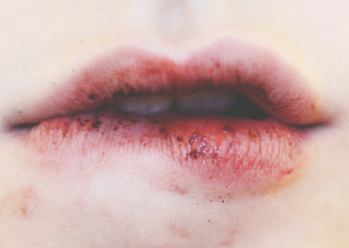 contusions