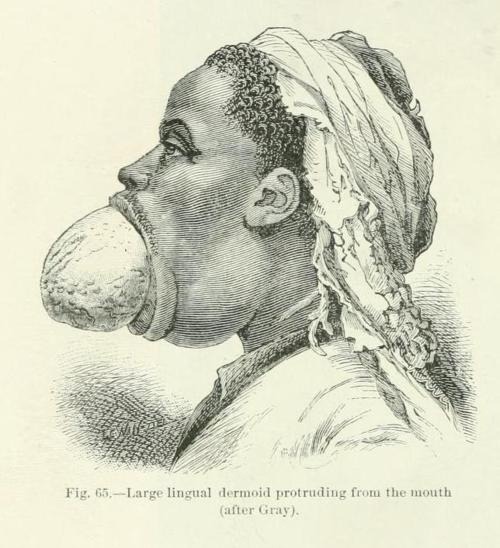 From Anomalies and Curiosities of Medicine, by Walter L. Pyle and George M. Gould,