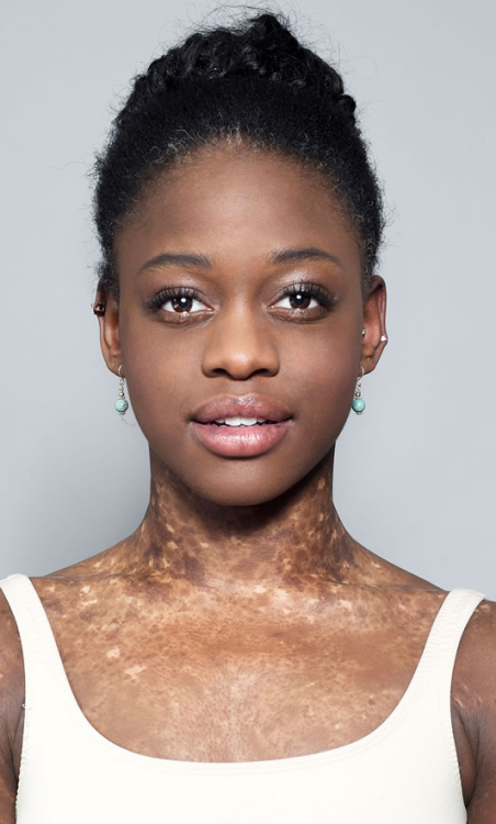 flyandfamousblackgirls: Vitiligo is a condition in which people lose melanin – the pigment that gives skin its color – resulting in white patches of skin. While the exact cause of vitiligo is unknown, it has been confirmed that an autoimmune component