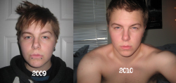 rugged-refined:  Top left: July 2009, 17 years old, pre-testosterone Top right: July 21, 2010, 18 years old, 1 year on testosterone Bottom: July 21, 2015, 23 years old, 6 years on testosterone 