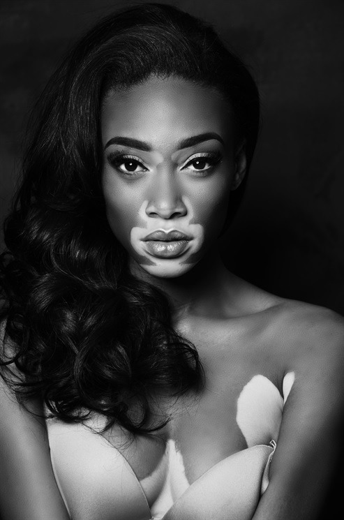 thefashionyoleauxist:Chantelle Brown-Young / Winnie Harlow.