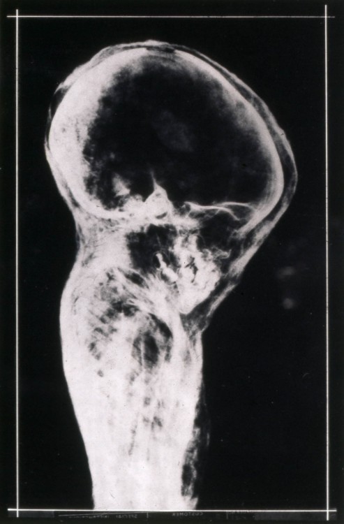 Mummy x-ray of a young male child. Name unknown (Roman Period) ~ British Museum Archives 