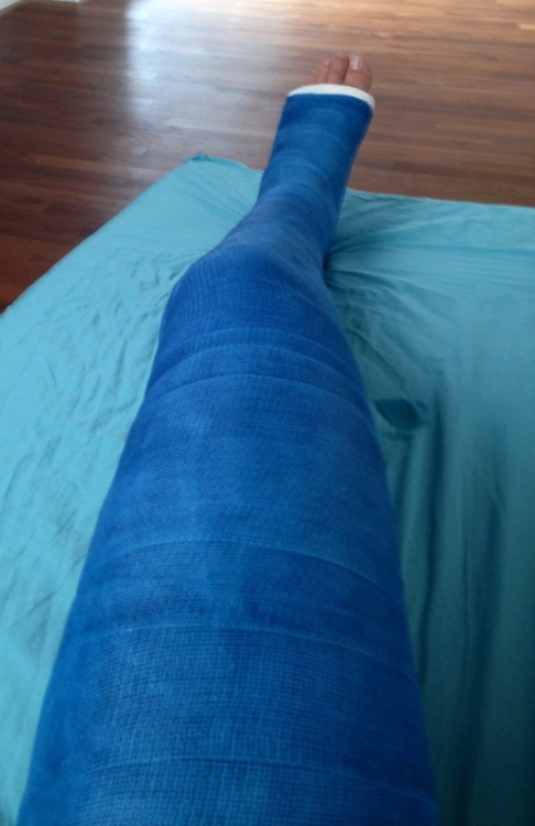 gehgips: Some leg casts I had over the years