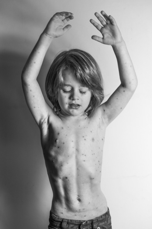 Chicken Pox at 4 years, 8 months.I’m delighted to share that Indigo’s portrait was selec