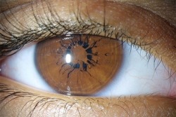 ewok-gia:  Persistent pupillary membrane