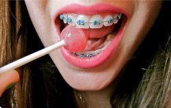 littlevirginprincess:  Braces are literally