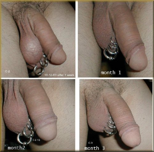 ban-ric:  (These pictures aren’t mine, here is the source)If you’re ever feeling disappointed about being circumcised, you can always restore your foreskin like the man in the pictures above did. It only took him 2 years to achieve the last picture,