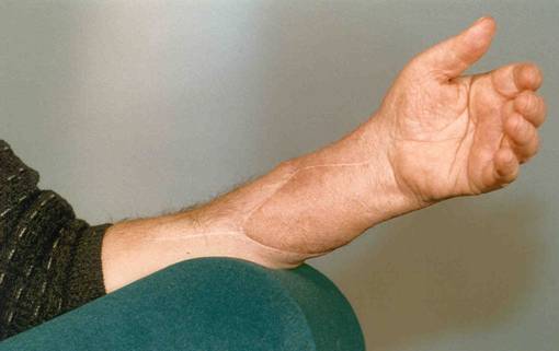 tehblurredline:  Watching an interesting doco on hand transplants in the U.K and