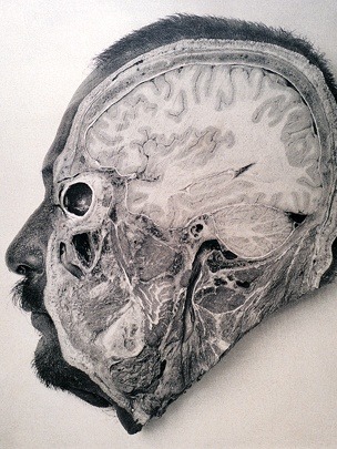 “Dissecting the criminal brain. This 1904 photograph by Argentinian physician Dr. F. Perez shows a section of an executed criminal’s brain. Unfortunately, his work merited little results - he found no major differences between the brains of