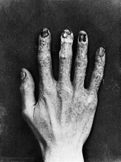 sixpenceee:  The above is the hand of an early X-ray machine operator. Early radiologists would calibrate their X-ray machines by sticking their hands in the beam. They would draw lines amounting to 30 second intervals starting at their fingertips and