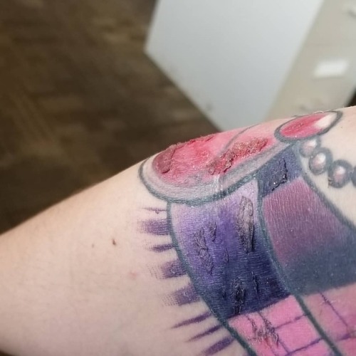 At the gross stage of healing lol