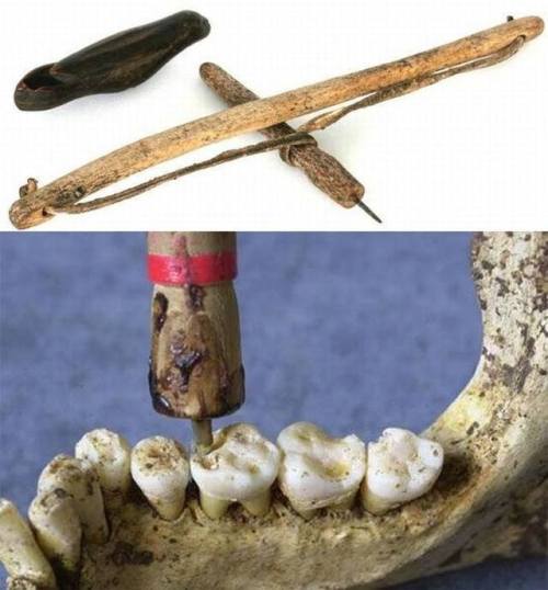 Neolithic teeth found at Mehrgarh(Pakistan).These teeth, dating to around 7000 BC, show some of the 